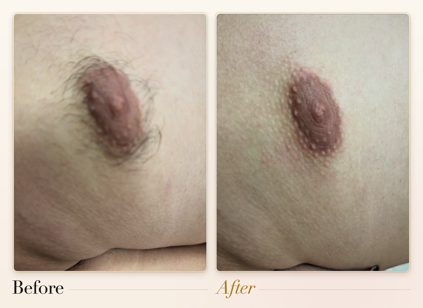 A close-up of the chest before and after waxing